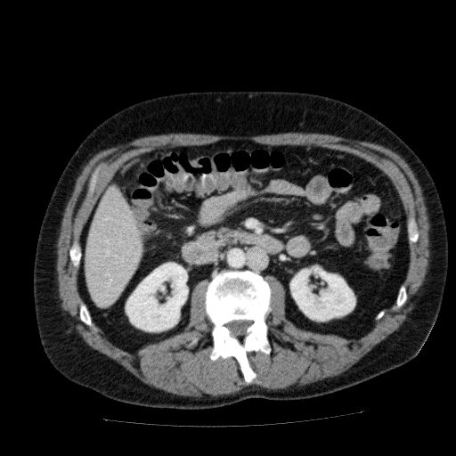 File:Acute cholecystitis and incidental left sided IVC (Radiopaedia 49352-54459 Axial C+ portal venous phase 71).jpg