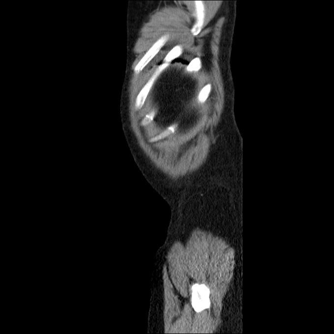 Acute cholecystitis and incidental left sided IVC (Radiopaedia 49352-54459 Sagittal C+ portal venous phase 9).jpg