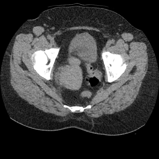 File:Acute cholecystitis and ureteric colic (Radiopaedia 42330-45444 Axial prone 100).jpg