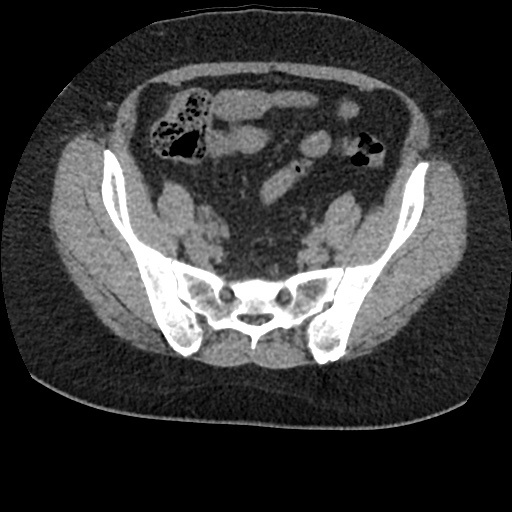 File:Acute cholecystitis and ureteric colic (Radiopaedia 42330-45444 Axial prone 82).jpg
