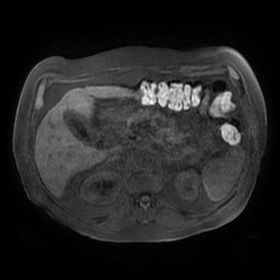 Acute cholecystitis complicated by pylephlebitis (Radiopaedia 65782-74915 Axial T1 fat sat 54).jpg
