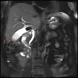 File:Acute cholecystitis with gallbladder neck calculus (Radiopaedia 42795-45971 Coronal T2 Half-fourier-acquired single-shot turbo spin echo (HASTE) 3).jpg