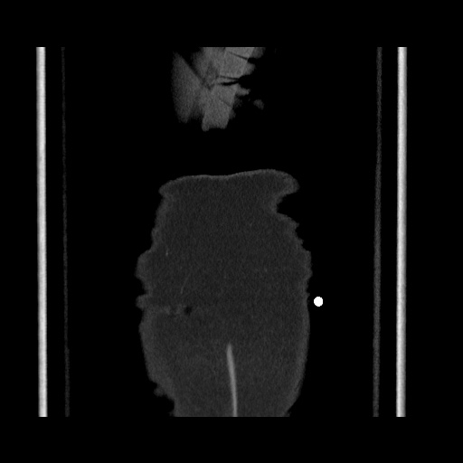 Acute cholecystitis with tensile fundus sign (Radiopaedia 71394-81723 Coronal non-contrast 128).jpg