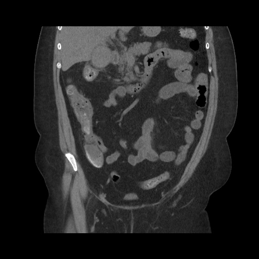 Acute cholecystitis with tensile fundus sign (Radiopaedia 71394-81723 Coronal non-contrast 57).jpg