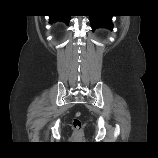 Acute cholecystitis with tensile fundus sign (Radiopaedia 71394-81723 Coronal non-contrast 95).jpg