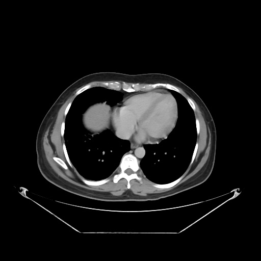 File:Acute complicated calculous cholecystitis (Radiopaedia 55202-61587 Axial C+ delayed 15).jpg