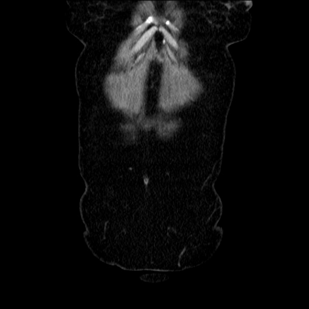 Acute diverticulitis (Radiopaedia 34183-35442 Coronal C+ portal venous phase 11).jpg