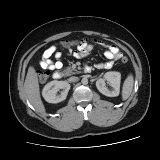 File:Acute diverticulitis with localized perforation (Radiopaedia 41296-44113 Axial C+ portal venous phase 36).jpg