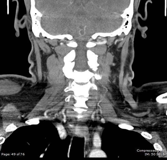 Acute epiglottitis (Radiopaedia 54375-60590 Coronal C+ arterial phase 49).jpg