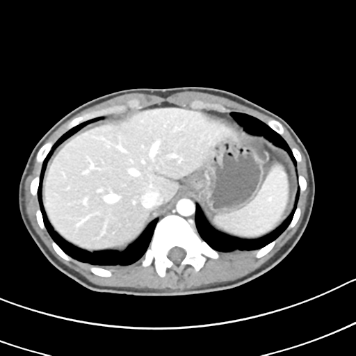 Acute gangrenous appendicitis with perforation (Radiopaedia 40152-42662 Axial C+ portal venous phase 10).png