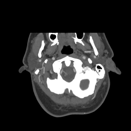 File:Acute internal carotid artery dissection (Radiopaedia 53541-59630 D 6).jpg