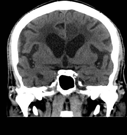Acute left anterior cerebral artery territory infarction (Radiopaedia 51785-57578 Coronal non-contrast 27).jpg