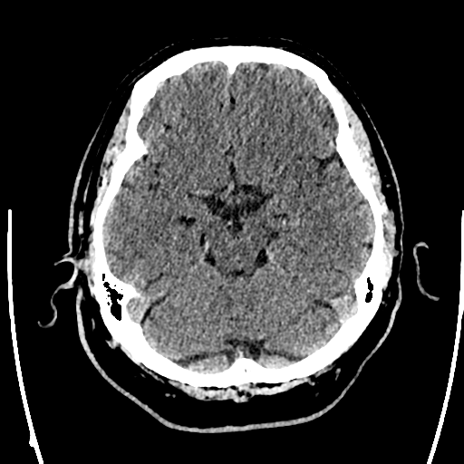 Acute left middle cerebral artery territory ischemic stroke (Radiopaedia 35688-37223 Axial non-contrast 27).png