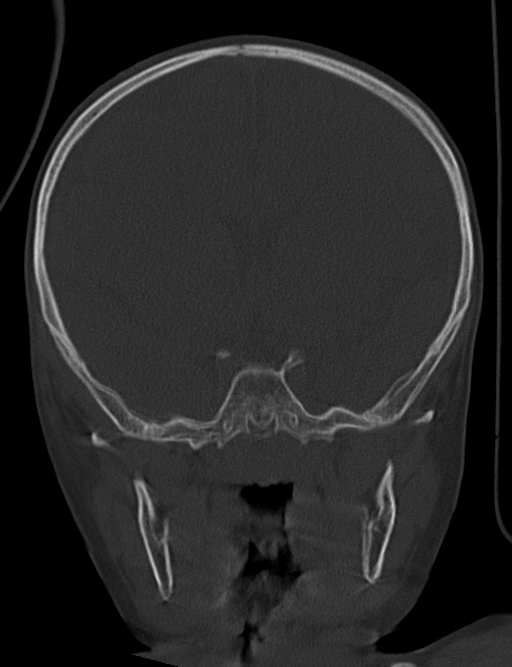 Acute mastoiditis (Radiopaedia 82678-96881 Coronal bone window 32).jpg