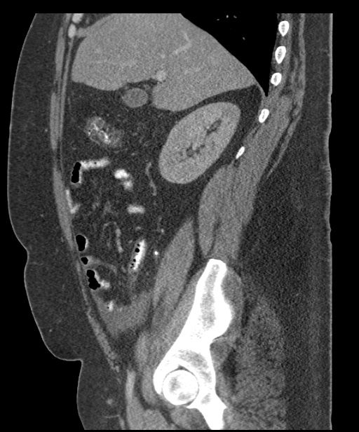 Acute mesenteric venous ischemia (Radiopaedia 46041-50383 Sagittal C+ portal venous phase 35).jpg