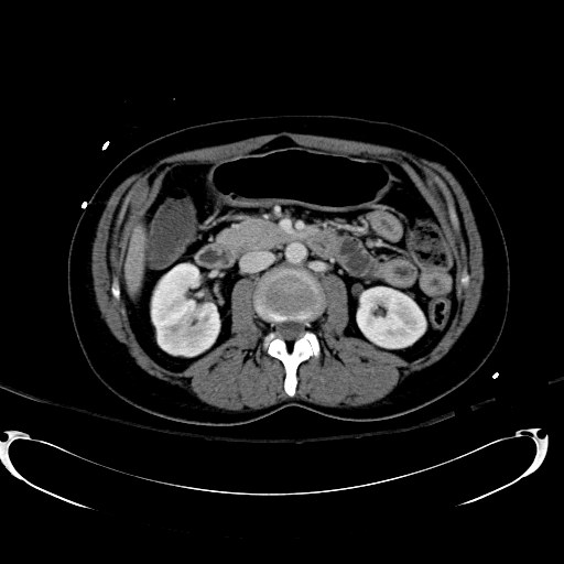 Acute myocardial infarction in CT (Radiopaedia 39947-42415 Axial C+ portal venous phase 56).jpg