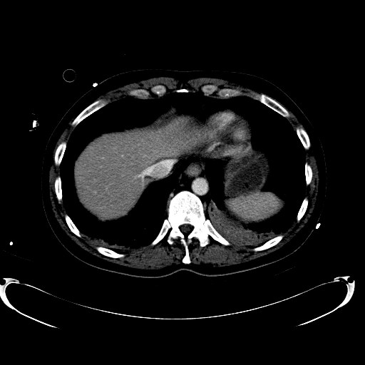 File:Acute myocardial infarction in CT (Radiopaedia 39947-42457 Axial C+ portal venous phase 17).jpg
