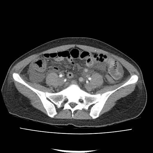 File:Acute myocarditis (Radiopaedia 55988-62613 Axial C+ portal venous phase 55).jpg