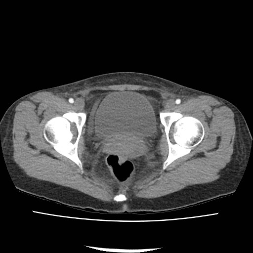 Acute myocarditis (Radiopaedia 55988-62613 Axial C+ portal venous phase 76).jpg