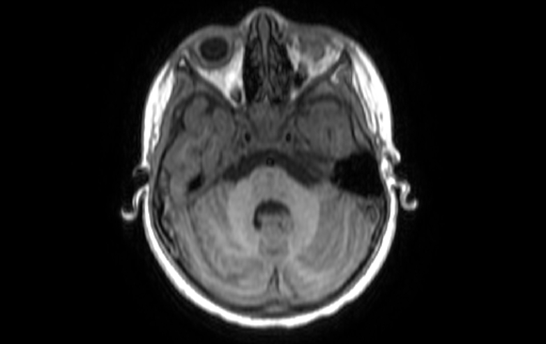 Acute necrotizing encephalitis of childhood (Radiopaedia 67356-76737 Axial T1 72).jpg