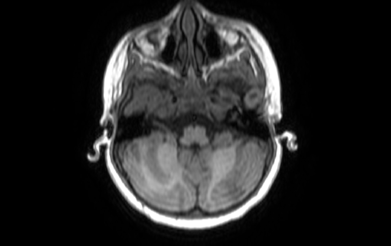 Acute necrotizing encephalitis of childhood (Radiopaedia 67356-76737 Axial T1 76).jpg