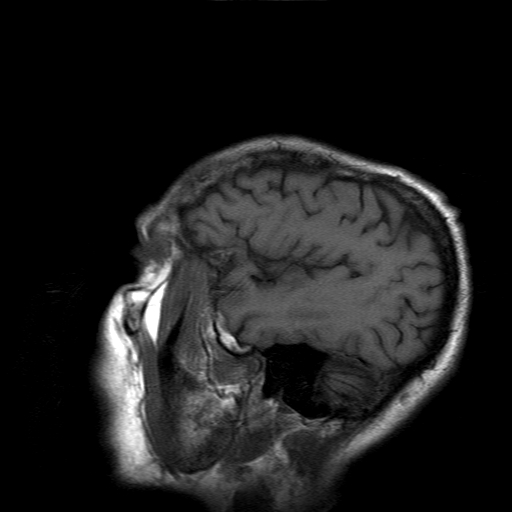 File:Acute necrotizing toxoplasma encephalitis (Radiopaedia 10683-11149 Sagittal T1 fat sat 16).jpg