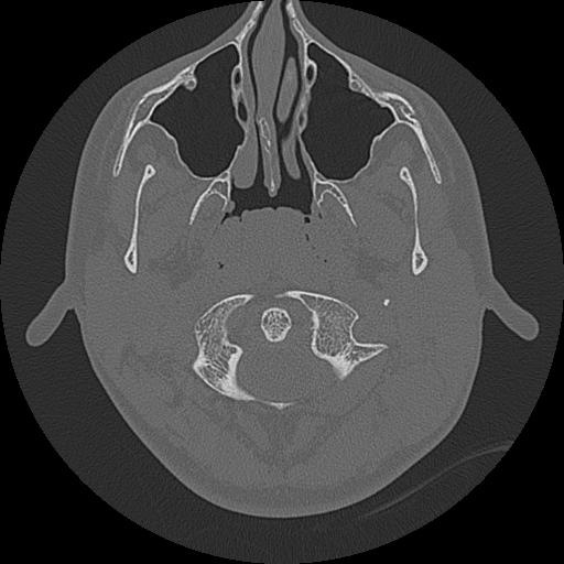 File:Acute otomastoiditis and Bezold abscess (Radiopaedia 88184-104786 Axial bone window 2).jpg