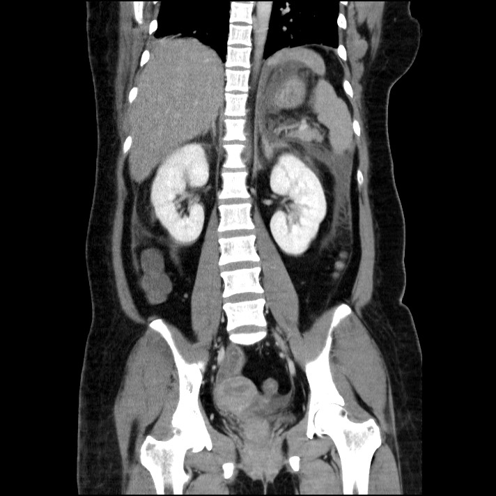 Acute pancreatitis (Radiopaedia 69236-79012 Coronal C+ portal venous phase 33).jpg