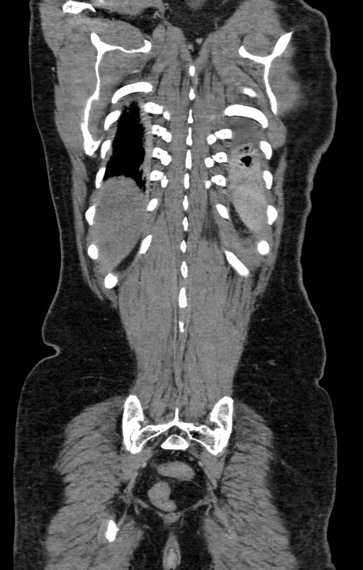 Acute pancreatitis (Radiopaedia 80007-93285 Coronal C+ portal venous phase 130).jpg