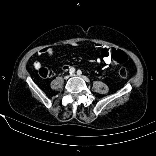 Acute pancreatitis (Radiopaedia 85146-100701 Axial C+ portal venous phase 45).jpg