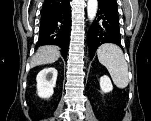 Acute pancreatitis (Radiopaedia 85146-100701 Coronal C+ portal venous phase 58).jpg