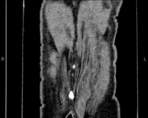 Acute pancreatitis (Radiopaedia 85146-100701 Coronal C+ portal venous phase 76).jpg