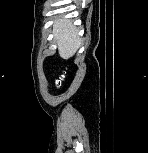 Acute pancreatitis (Radiopaedia 85390-101010 Sagittal C+ portal venous phase 3).jpg