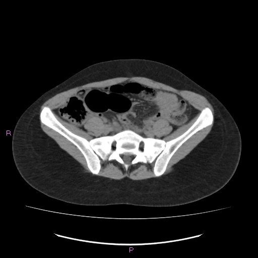 Acute pancreatitis secondary to stone at minor papilla and pancreatic divisum (Radiopaedia 76570-88333 Axial non-contrast 54).jpg