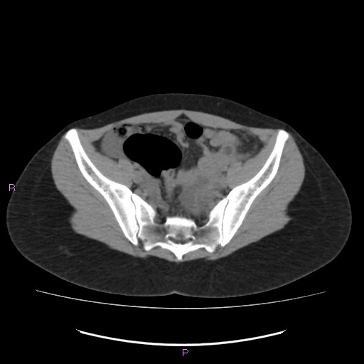 Acute pancreatitis secondary to stone at minor papilla and pancreatic divisum (Radiopaedia 76570-88333 Axial non-contrast 61).jpg