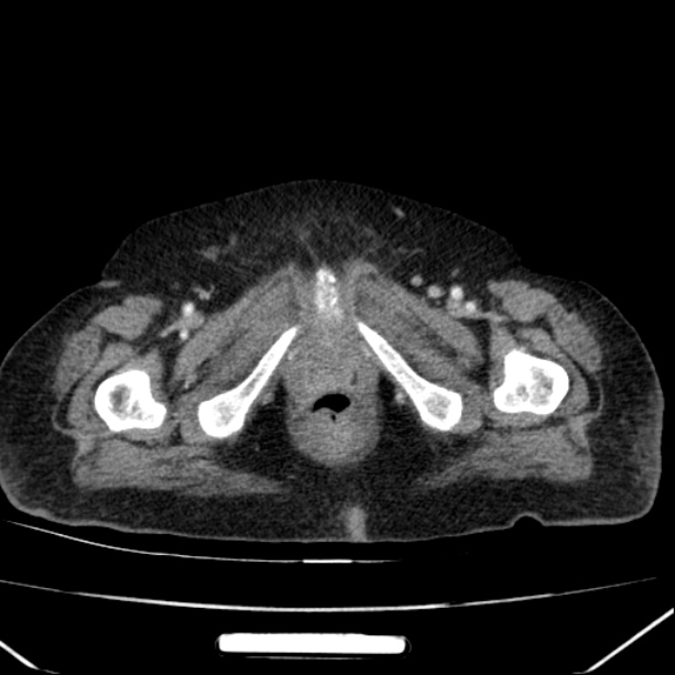 Acute pyelonephritis (Radiopaedia 26584-26729 Axial renal cortical phase 78).jpg