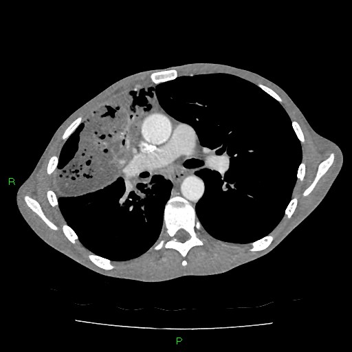 File:Acute right lung abscess (Radiopaedia 34806-36258 Axial C+ arterial phase 84).jpg