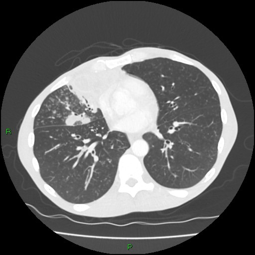 Acute right lung abscess (Radiopaedia 34806-36258 Axial lung window 116).jpg