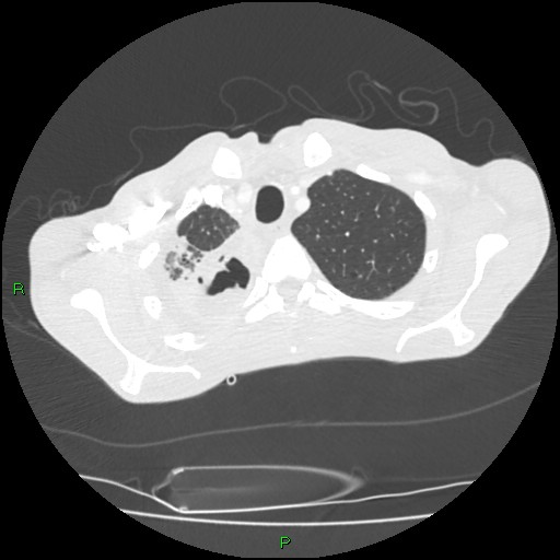 Acute right lung abscess (Radiopaedia 34806-36258 Axial lung window 25).jpg