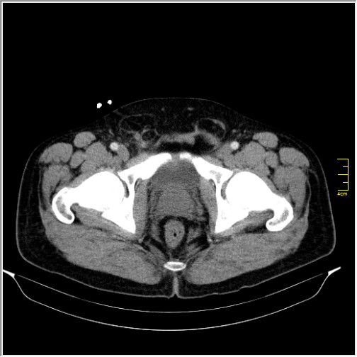 Acute right sided diverticulitis (Radiopaedia 65249-74268 Axial C+ portal venous phase 78).JPG