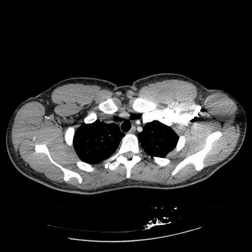 Acute segmental pulmonary emboli and pulmonary infarction (Radiopaedia 62264-70444 Axial C+ CTPA 23).jpg