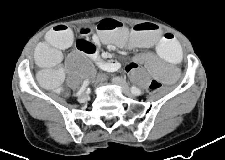 Acute small bowel (ileal) volvulus (Radiopaedia 71740-82139 Axial C+ portal venous phase 143).jpg