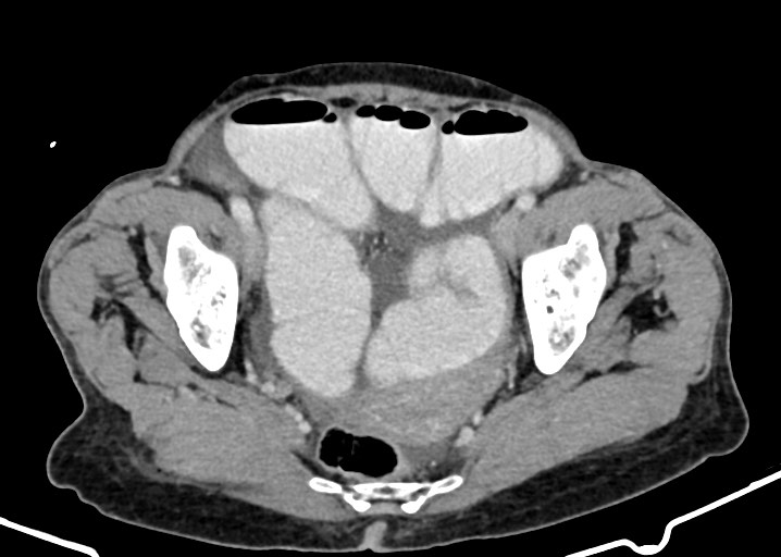 Acute small bowel (ileal) volvulus (Radiopaedia 71740-82139 Axial C+ portal venous phase 172).jpg