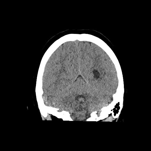 Acute subarachnoid hemorrhage and accessory anterior cerebral artery (Radiopaedia 69231-79008 Coronal non-contrast 52).jpg