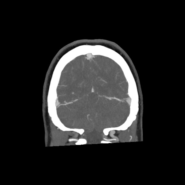 Acute subarachnoid hemorrhage and accessory anterior cerebral artery (Radiopaedia 69231-79009 Coronal C+ arterial phase 67).jpg