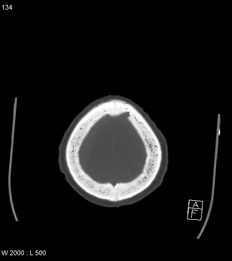 Acute subdural hematoma with myelofibrosis (Radiopaedia 52582-58494 Axial bone window 67).jpg