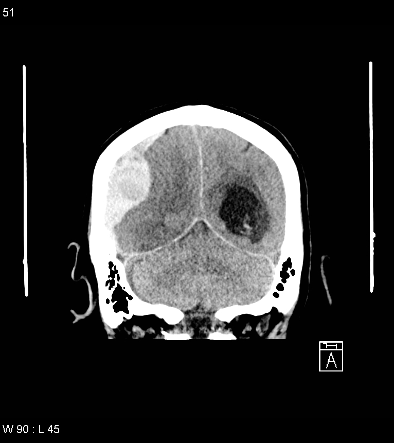 Acute subdural hematoma with myelofibrosis (Radiopaedia 52582-58494 Coronal non-contrast 42).jpg
