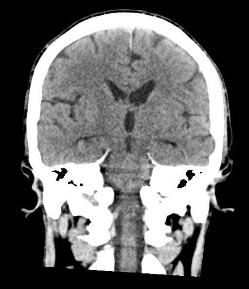 File:Acute superior cerebellar artery territory infarct (Radiopaedia 84104-99359 Coronal non-contrast 52).jpg