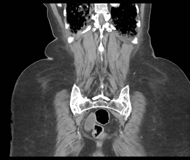 Acute superior mesenteric artery occlusion (Radiopaedia 43926-47418 Coronal C+ portal venous phase 43).png