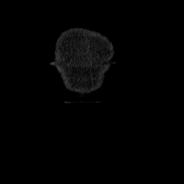Acute tubular necrosis (Radiopaedia 28077-28334 G 3).jpg